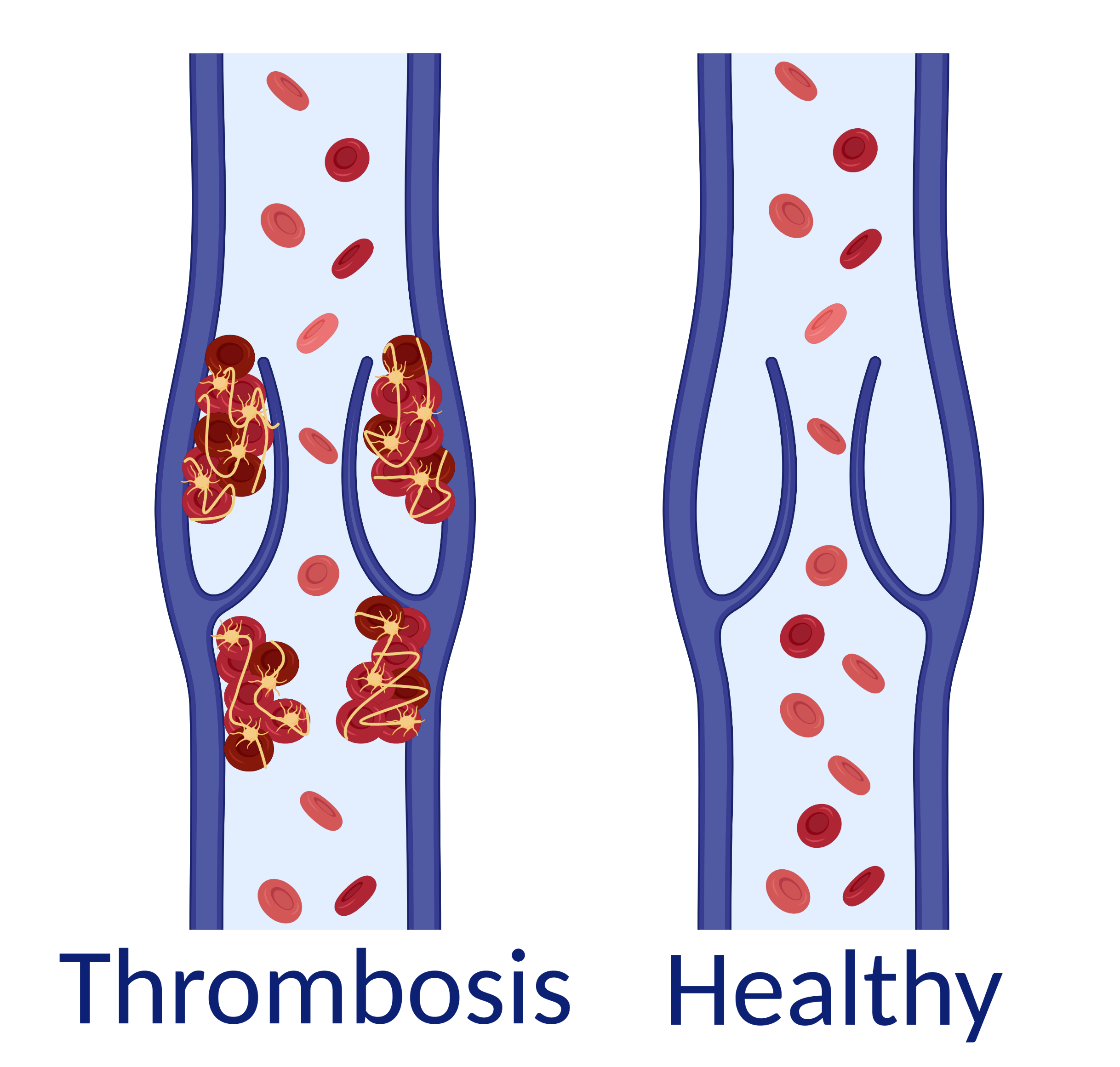 thrombosis in a vein and a healthy vein