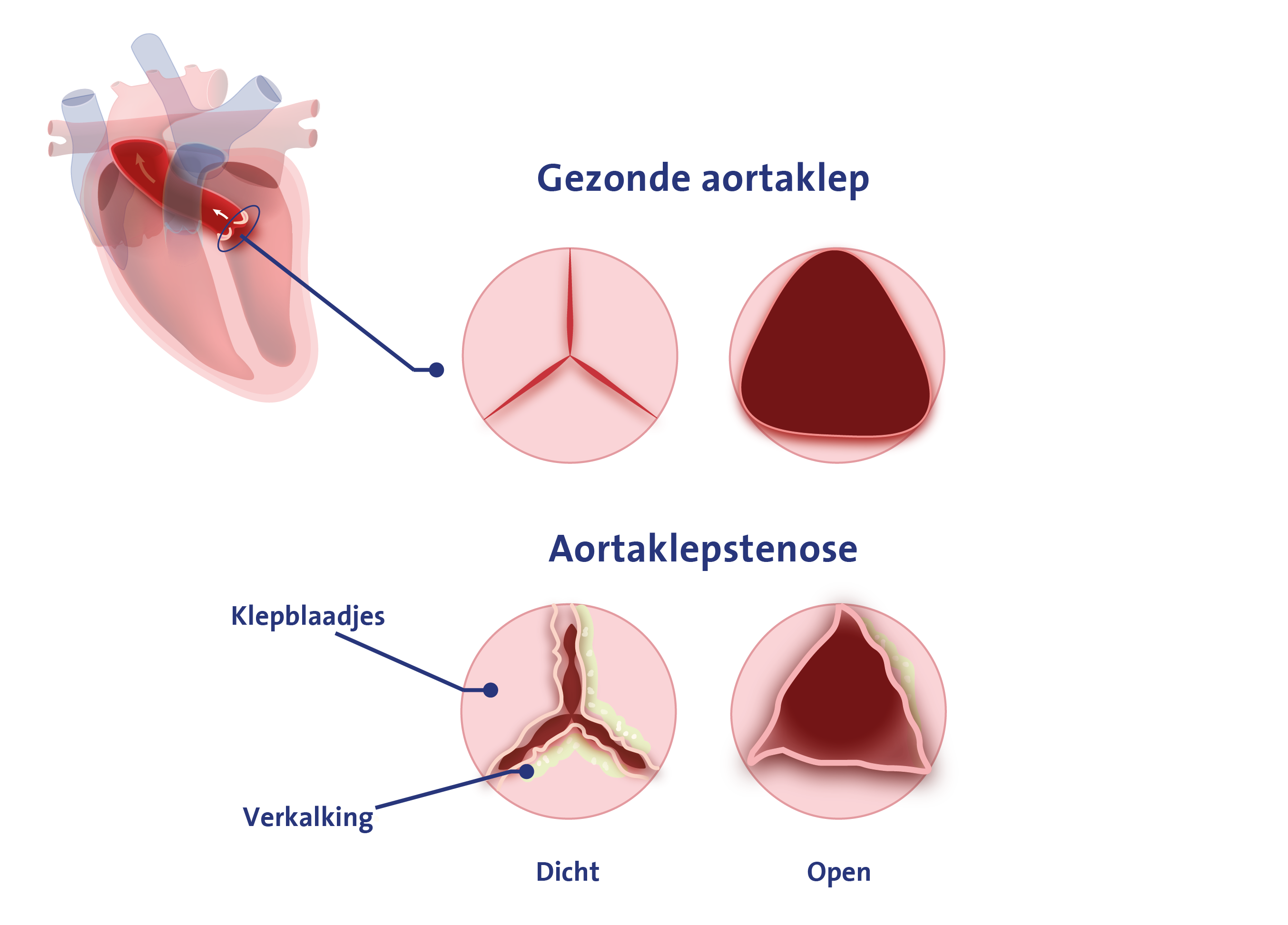 Afbeelding van aortaklep, gezond en aortaklepstenose