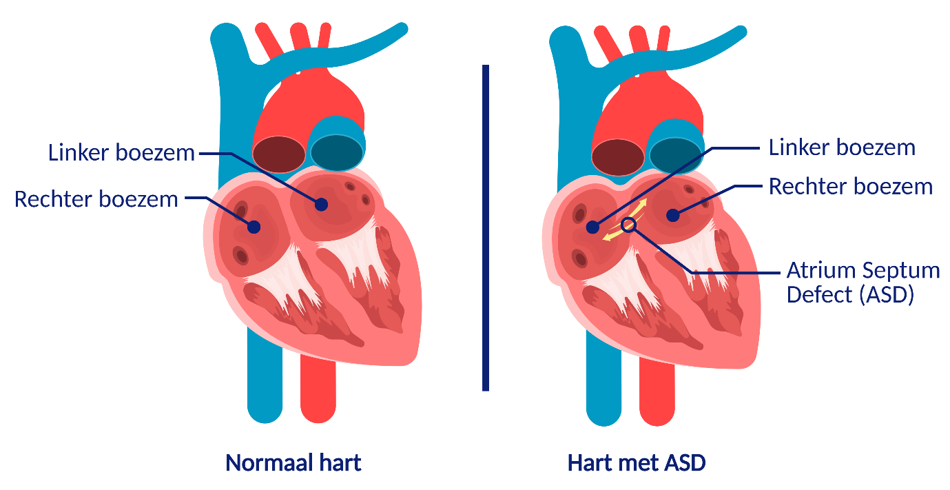 atrium septum defect (ASD) en een normaal hart