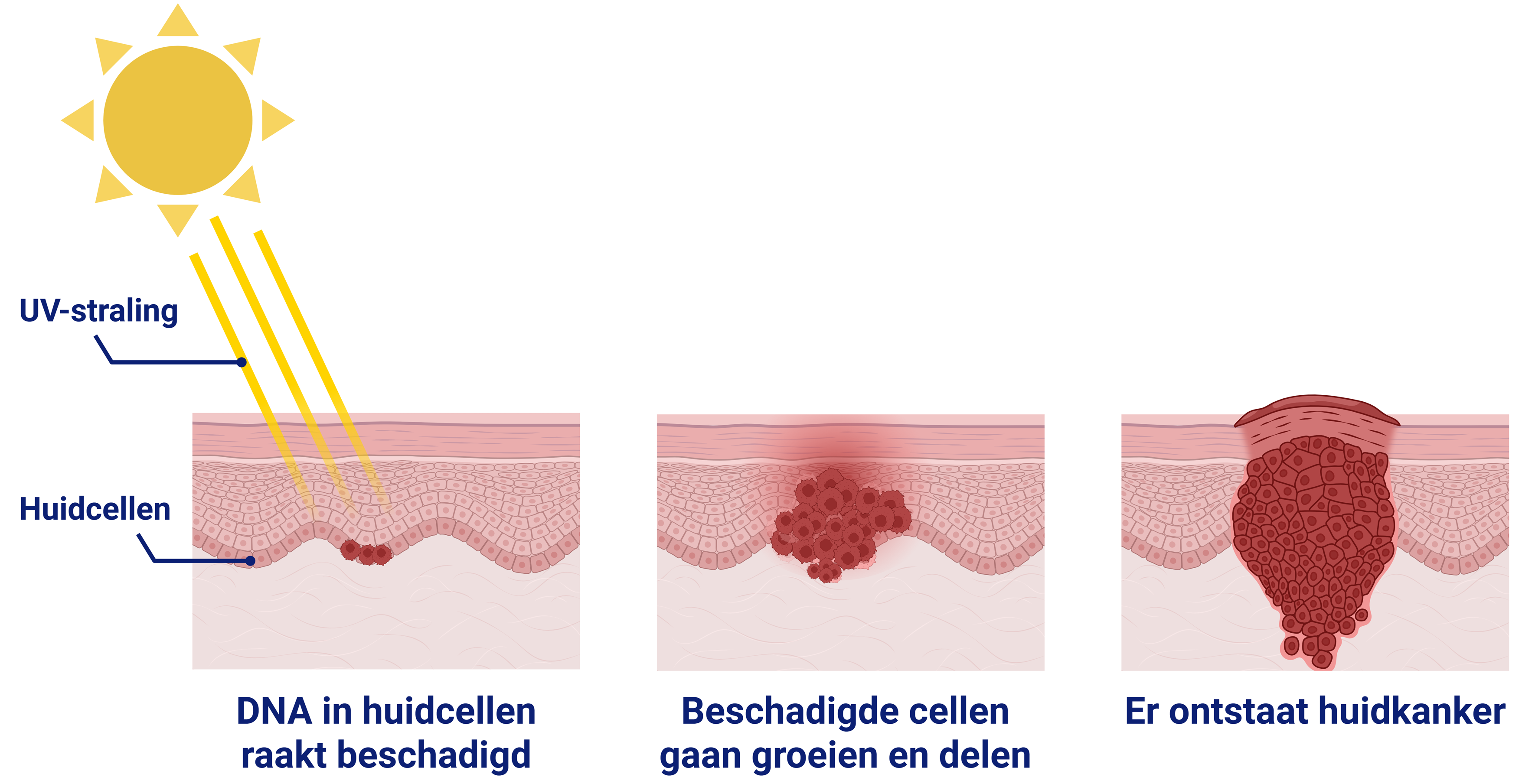 HHI-behandeling bij basaalcelcarcinoom - Patiëntenfolder - Erasmus MC