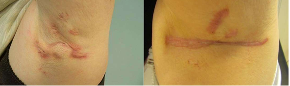 Oksel voor de operatie en oksel met litteken na de operatie