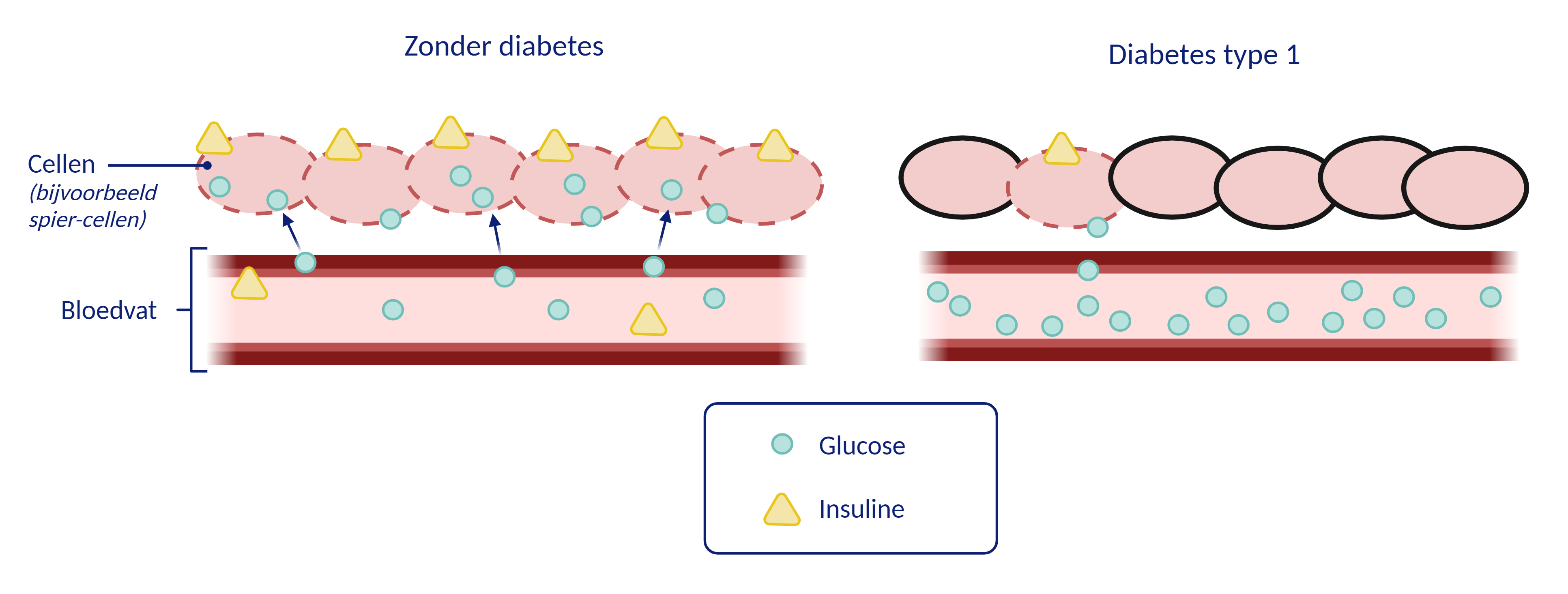 Diabetes type 1