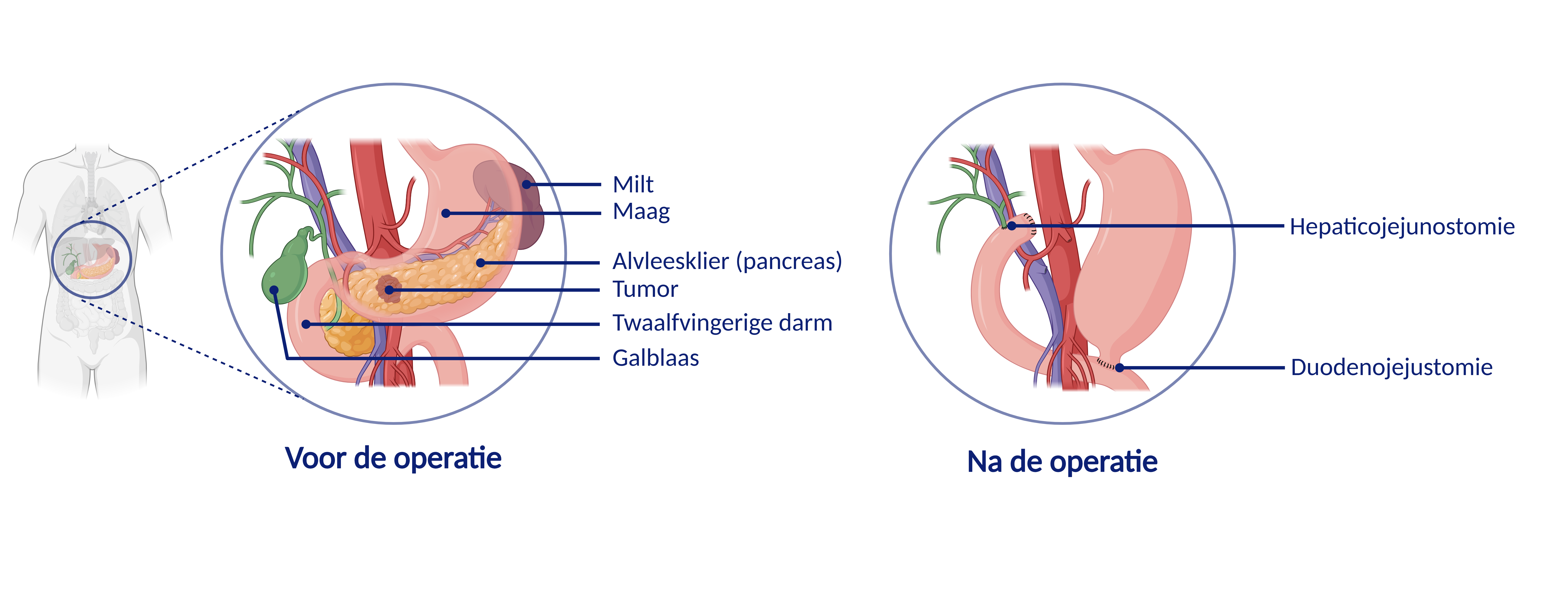 pancreatectomie