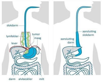 buismaagreconstructie