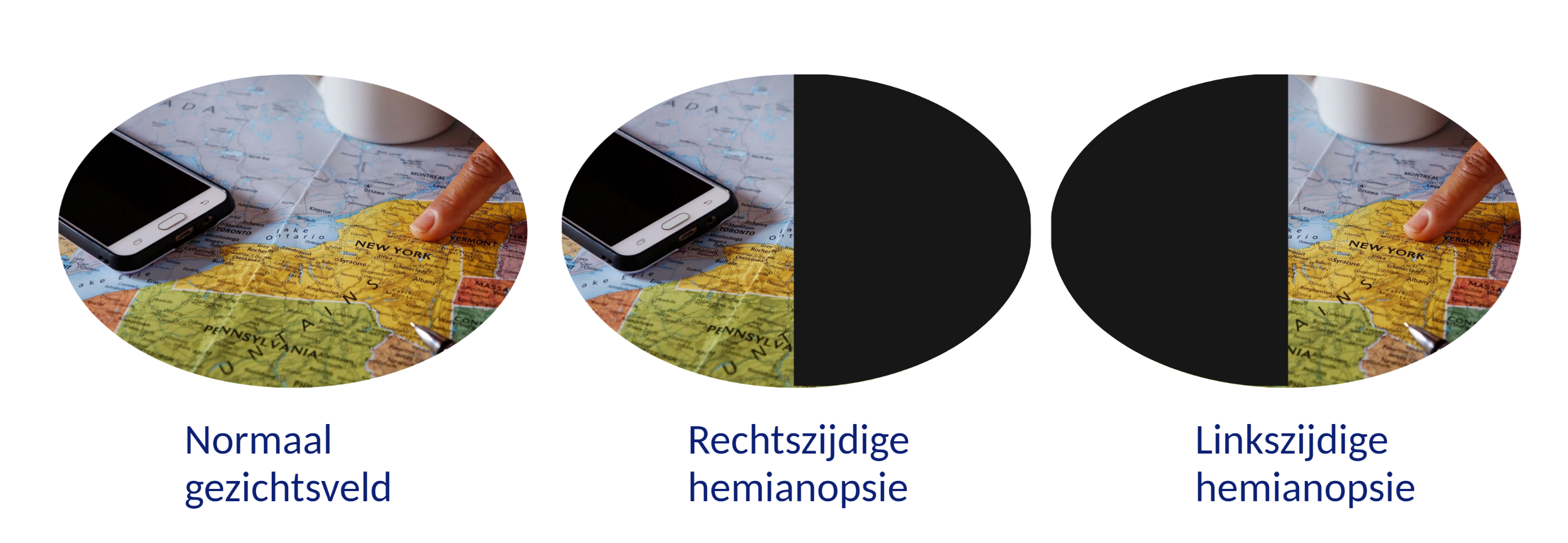 Gezichtsveld normaal (volledig beeld) - gezichtsveld rechtszijdige hemianopsie (rechts zwarts) - gezichtsveld linkszijdige hemianopsie (links zwart)