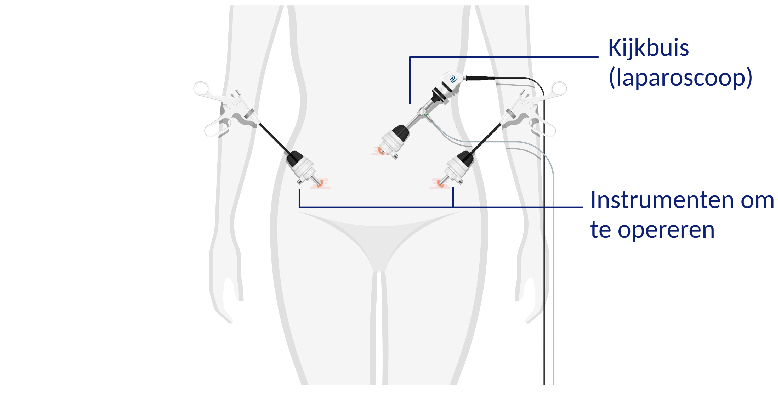 Lichaam tijdens operatie met 3 operatie-instrumenten. 1 kijkbuis (laparoscoop) vlak onder de navel en 2 instrumenten om mee te opereren