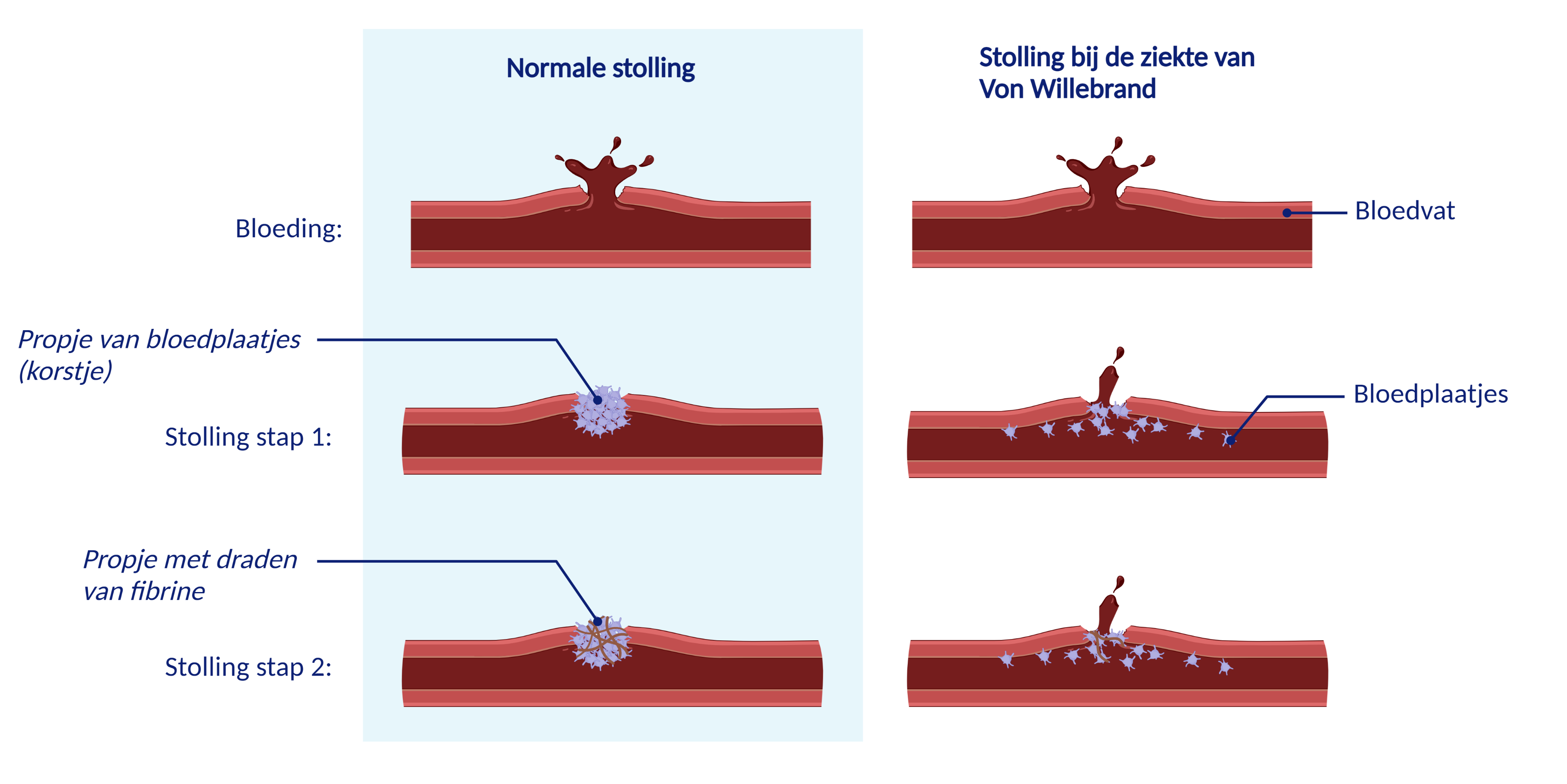 De ziekte van Von Willebrand - Patiëntenfolder - Erasmus MC