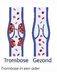 trombose in een ader
