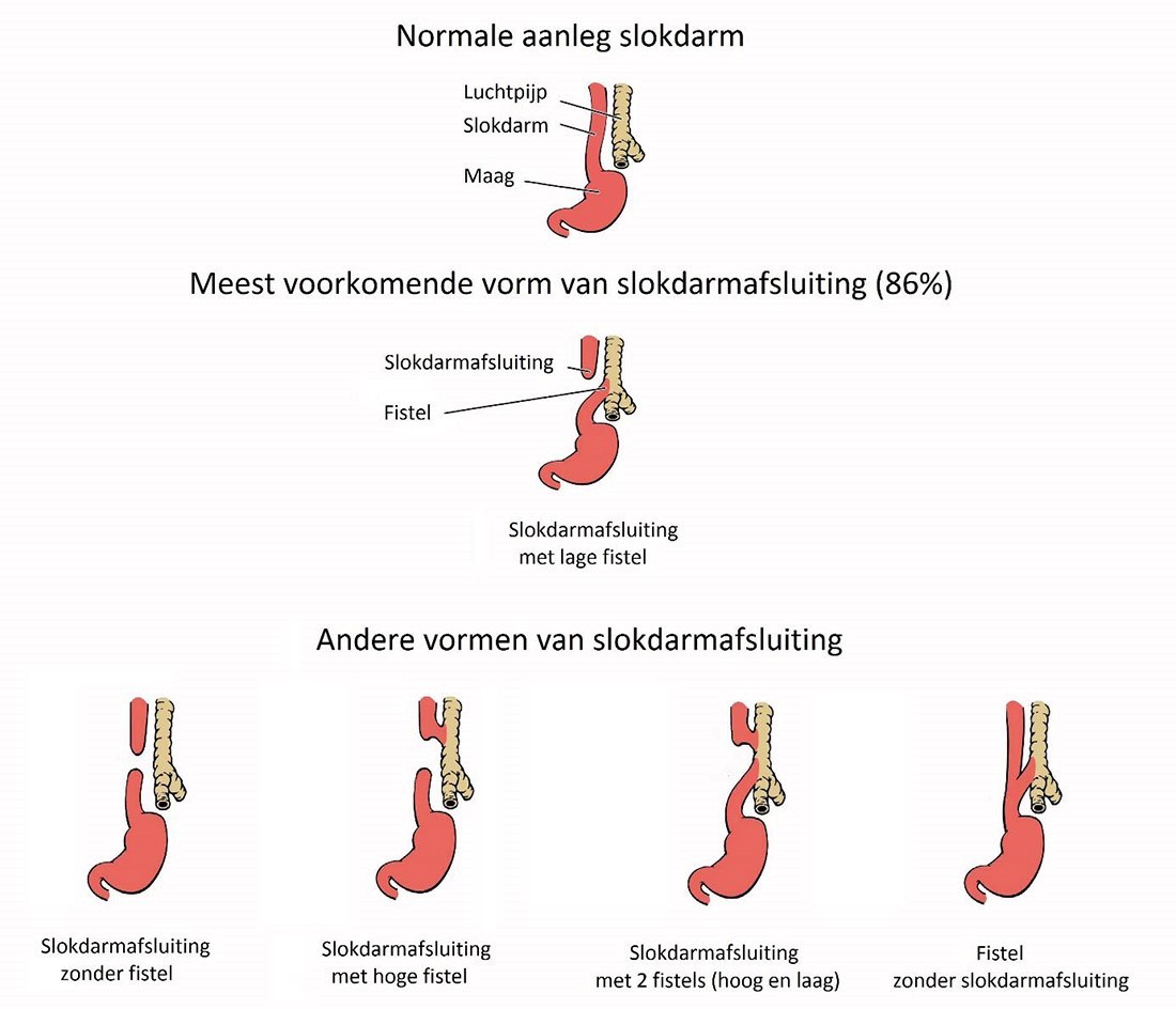 verschillende vormen slokdarmafsluiting