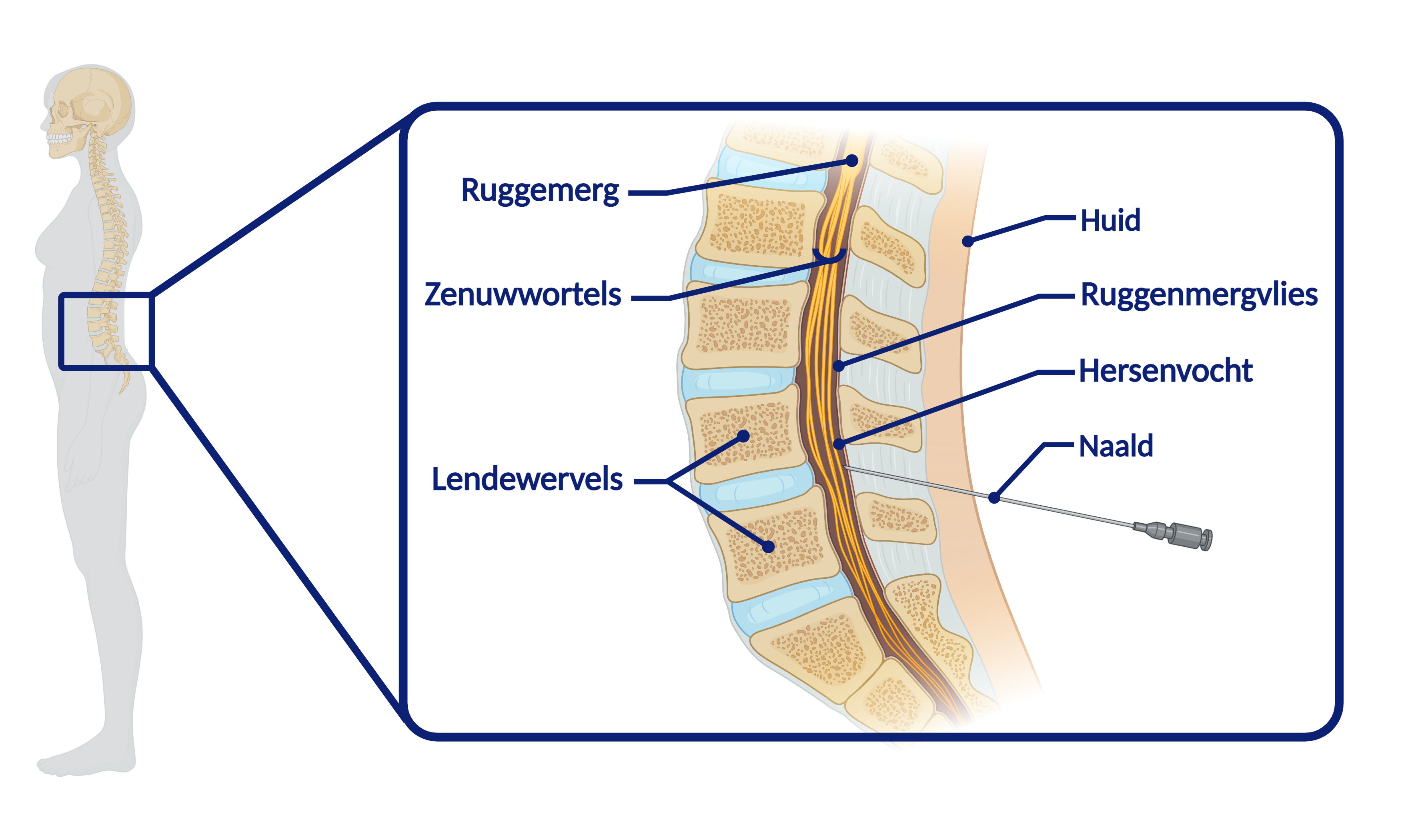 Insteekplaats voor de lumbaalpunctie