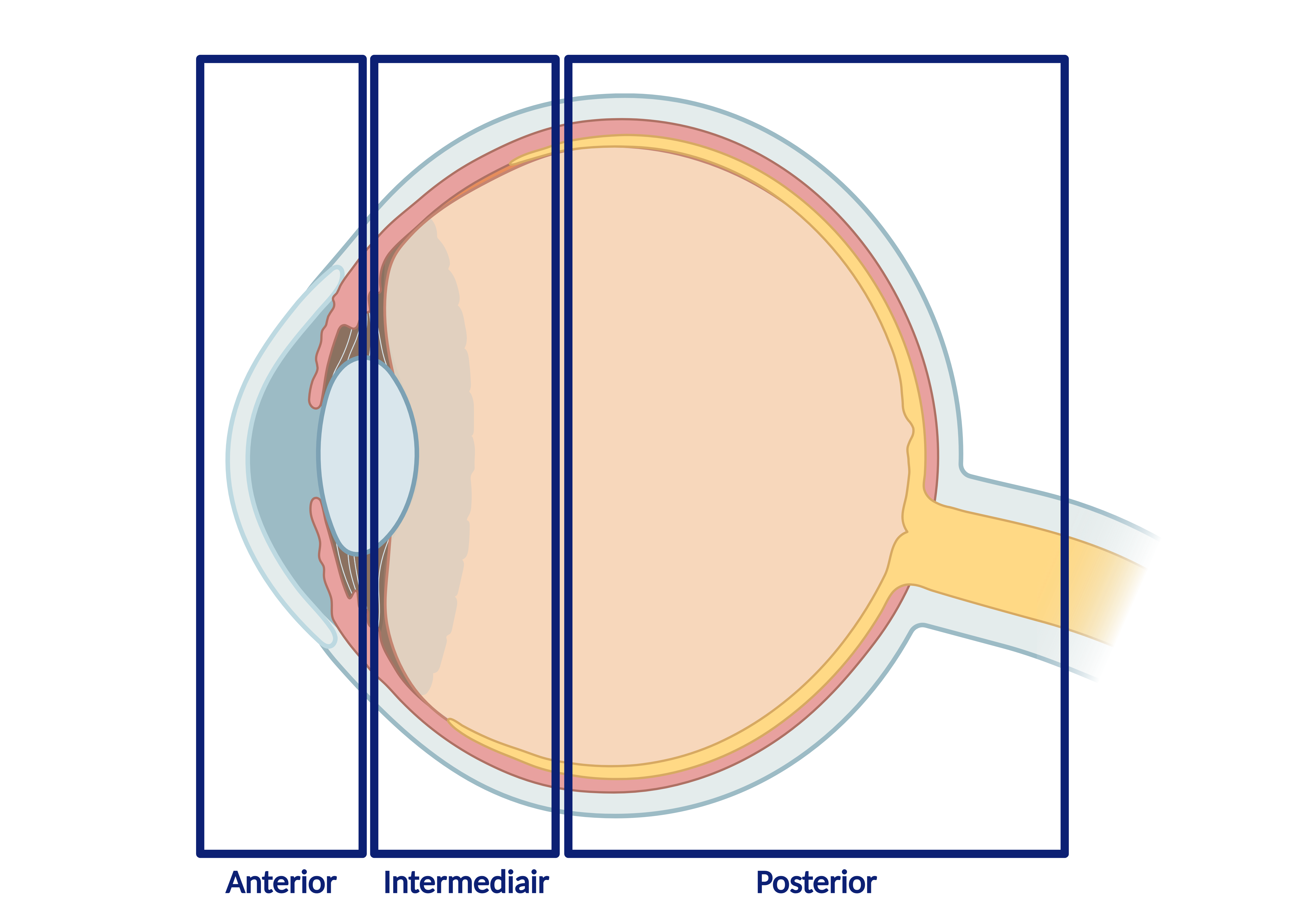 uveitis