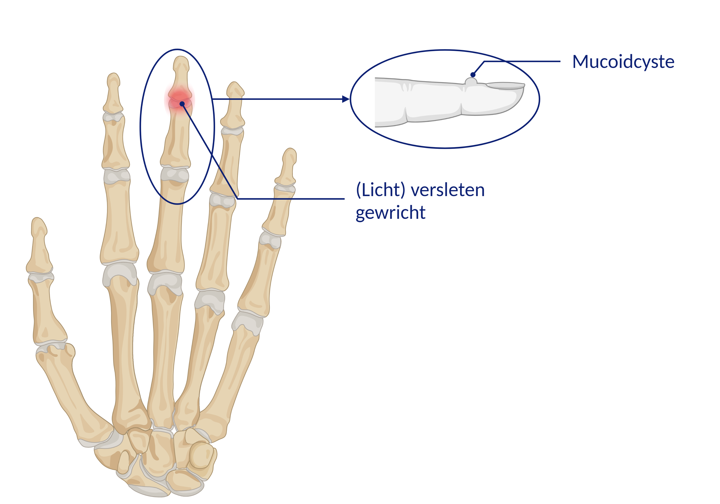 Mucoidcyste op de vinger - Patiëntenfolder - Erasmus MC