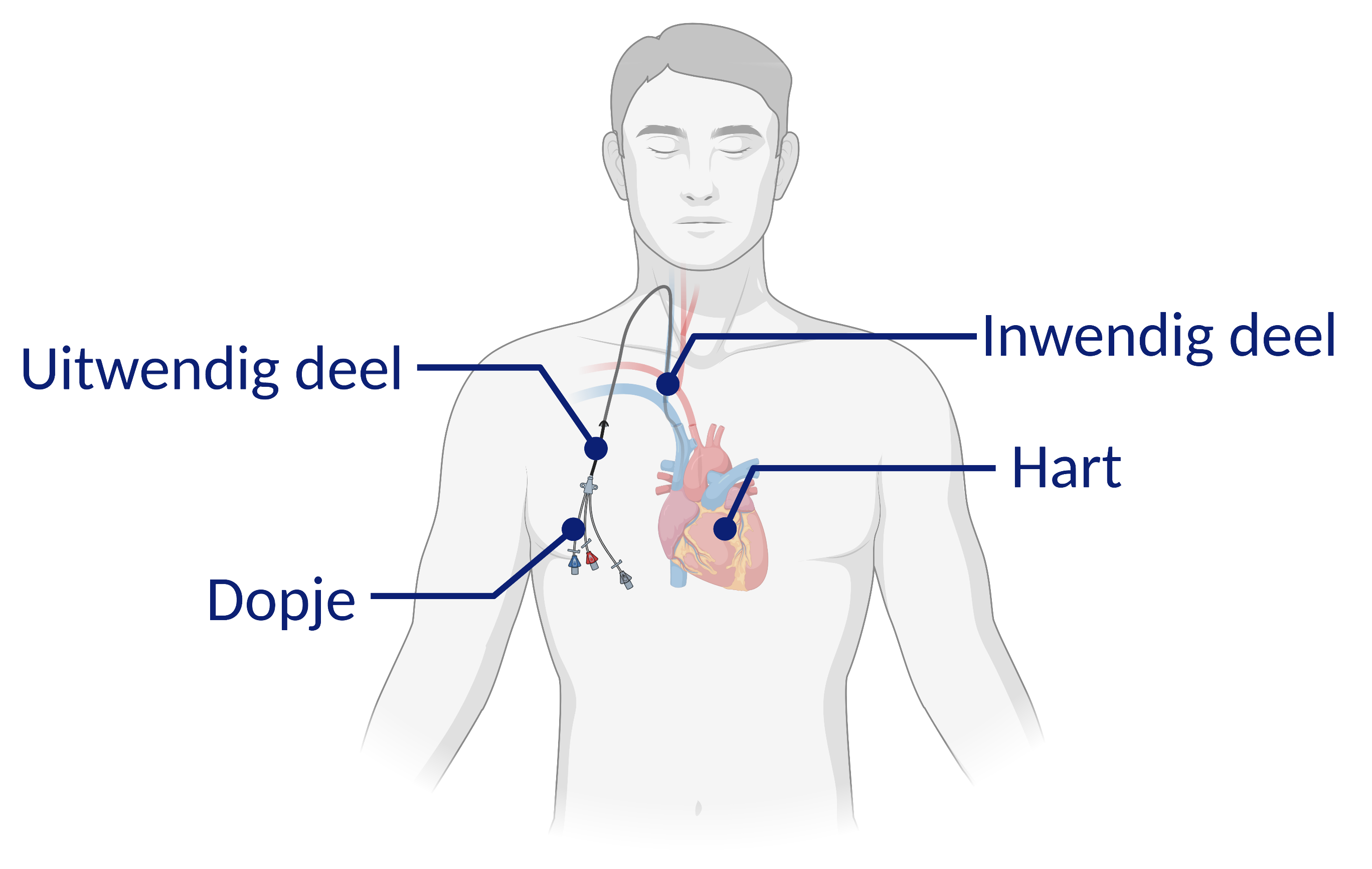 Inbrengen Hickman katheter Patiëntenfolder Erasmus MC