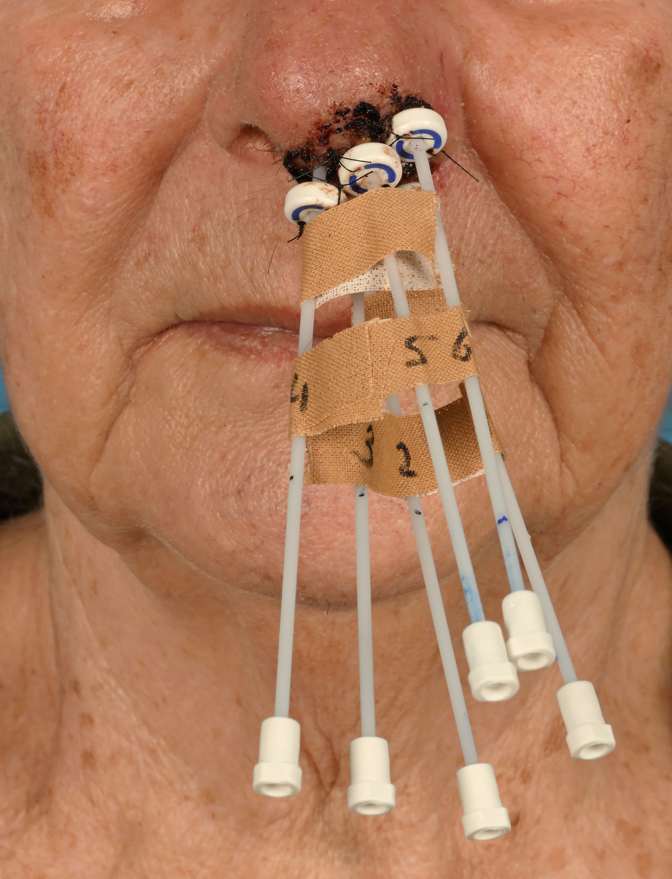 brachytherapie