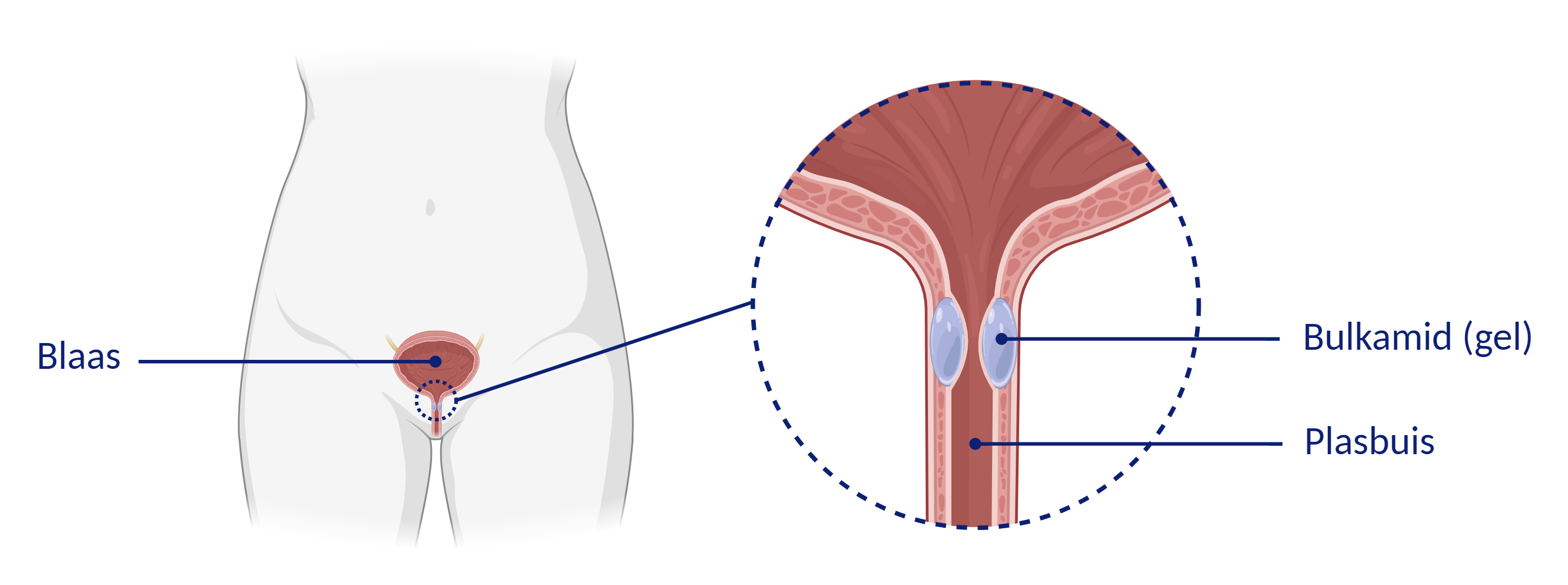 afbeelding 2: bulkamid in de plasbuis