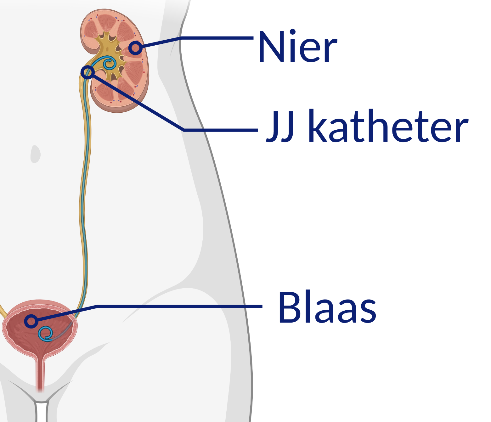 UPJ Stenose - Patiëntenfolder - Erasmus MC