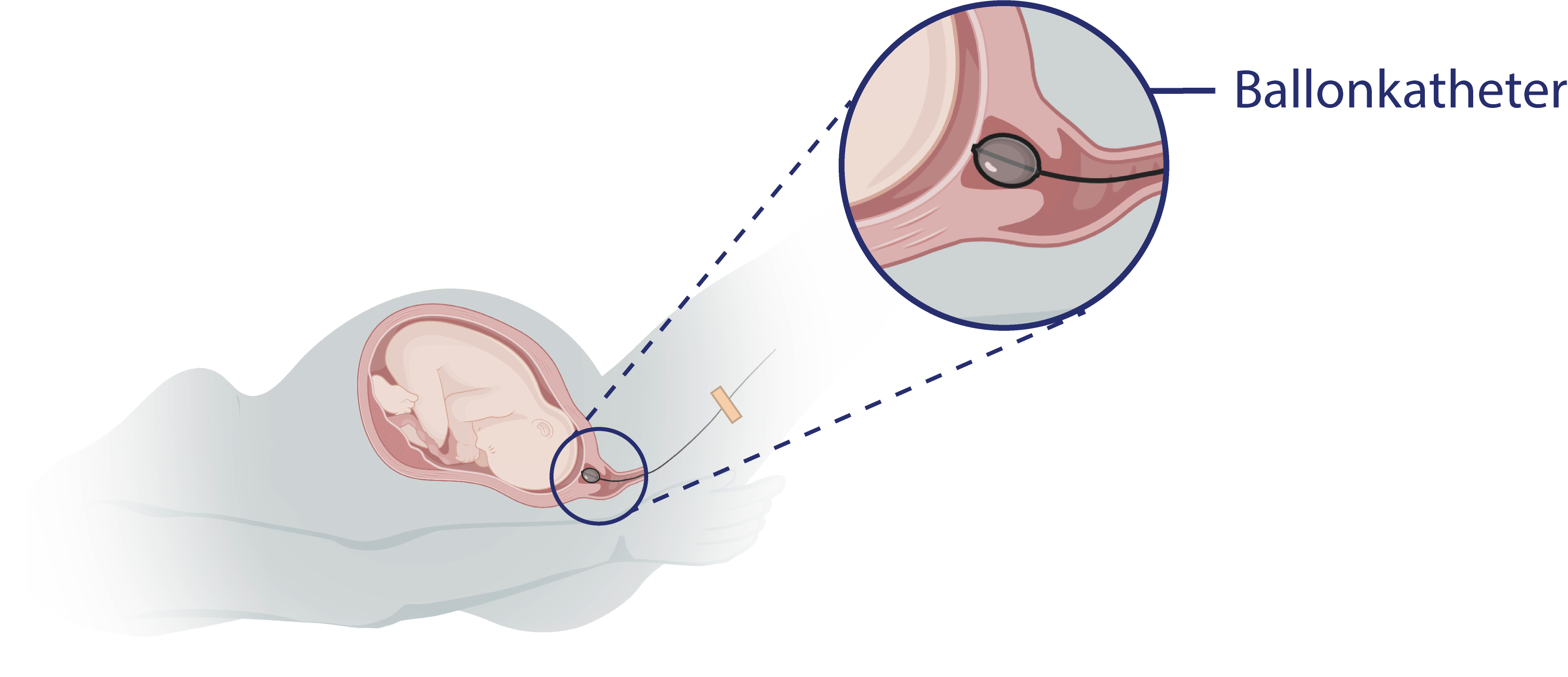inleiden bevalling door middel van ballonkatheter