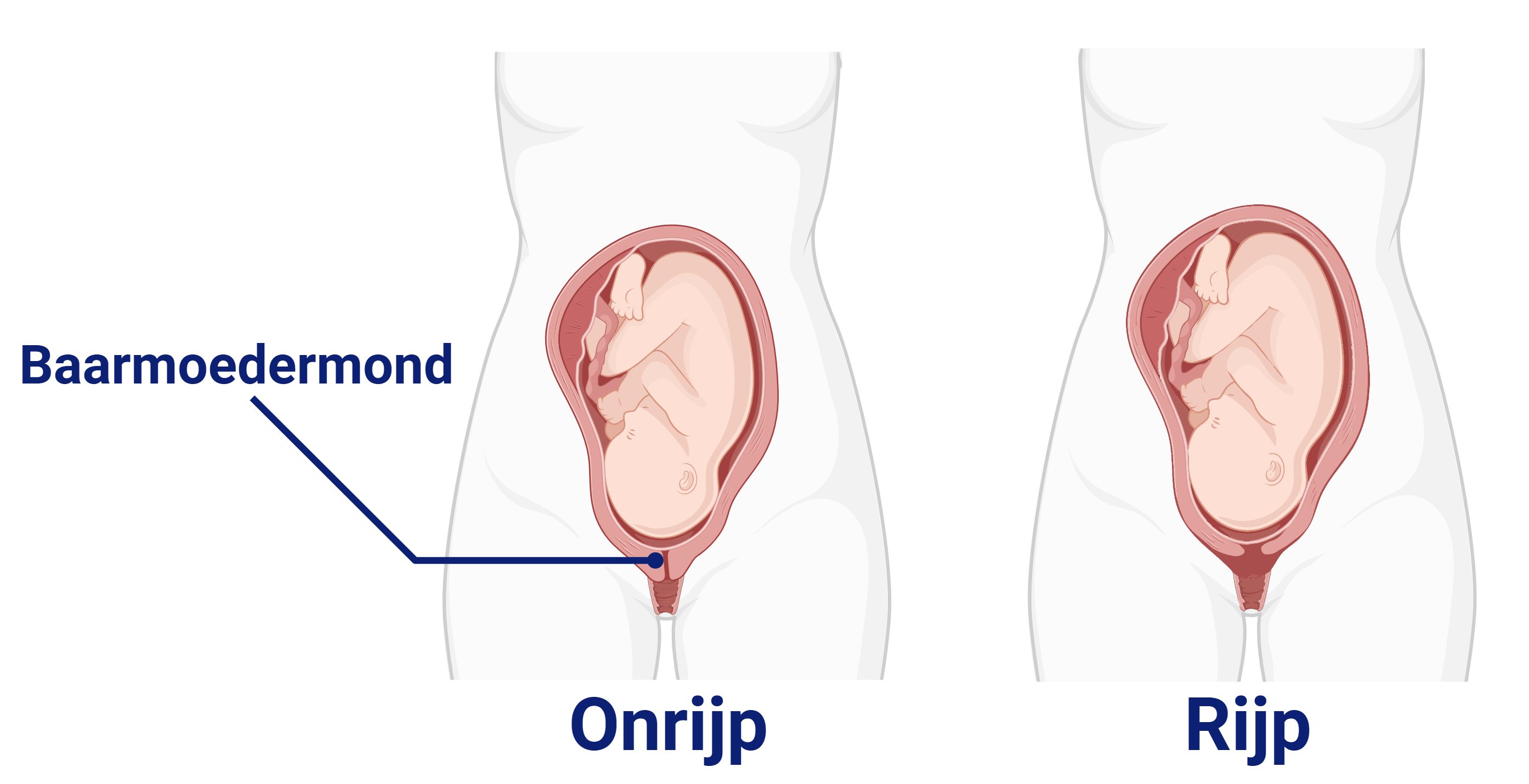 baarmoedermond rijp onrijp