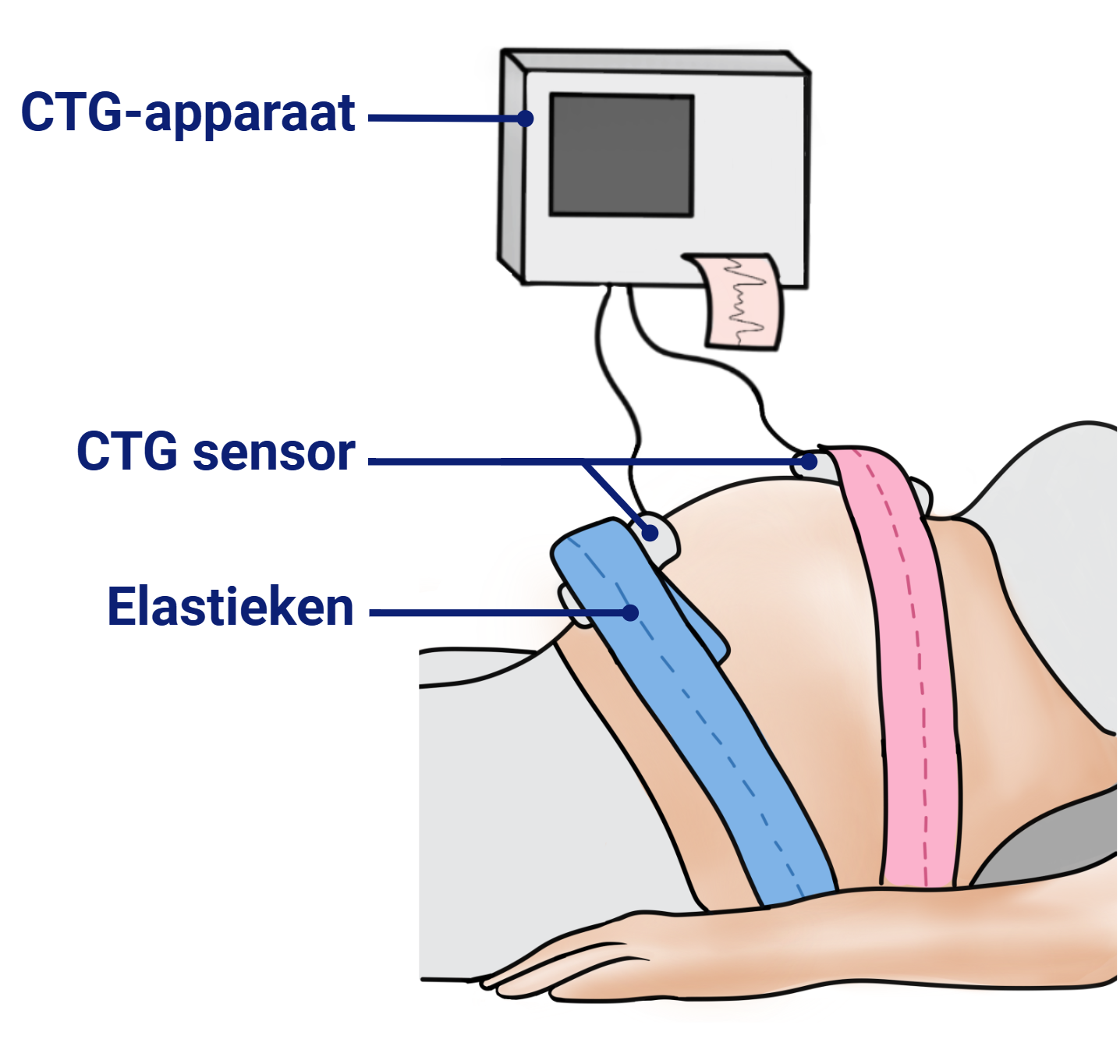 uitwendige ctg bij bevalling